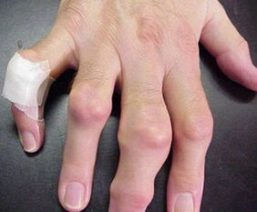 пръстите със ставни деформации причиняват болка