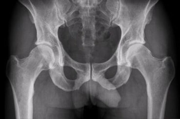 рентгенова снимка на тазобедрената става за болка