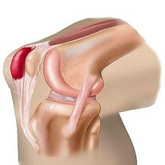 Една от причините за болка в колянната става е бурситът. 