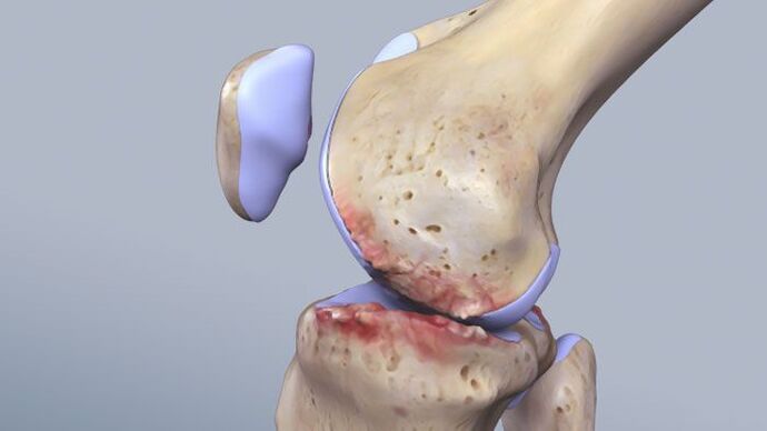 Структурата на колянната става, засегната от патология