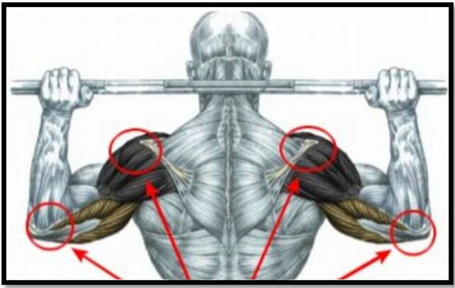 Натоварването на мускулите на рамото и лакътя е една от причините за артроза на раменната става